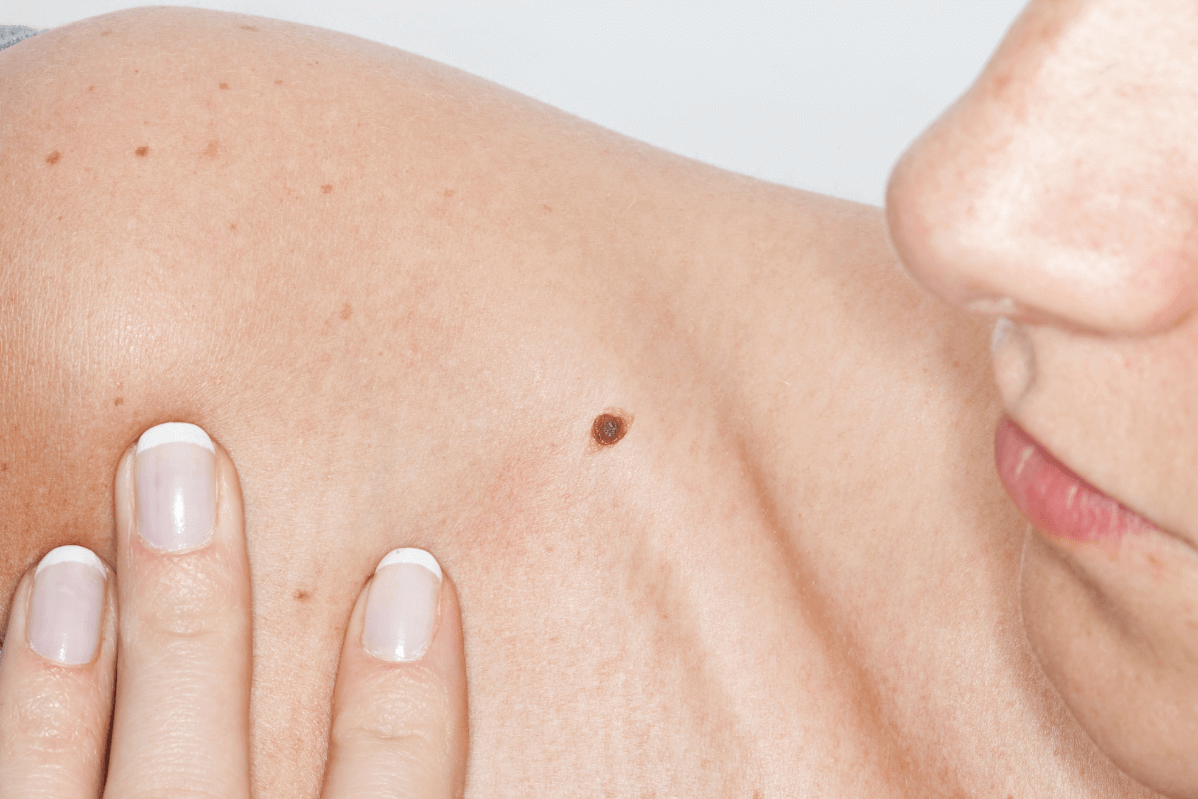 Person with a mole on their collar bone